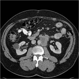 CT abdomen pelvis one year post left-hemicolectomy for pT4aN0M0 colonic adenocarcinoma, demonstrating rim-enhancing centrally