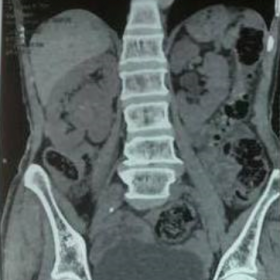Unenhanced CT. Coronal plane image depicting the mass within the renal sinus, and without fat or calcifications.