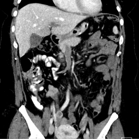 Coronal view of the abdomen in portal/venous phase (soft-tissue window) – Showing complete thrombosis in the superior mesen