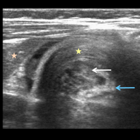 Diagnostic ultrasound. Transverse image at the right upper quadrant of the abdomen.