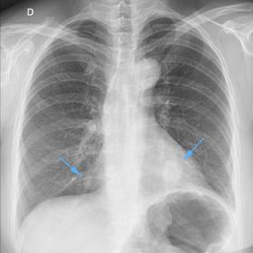 Chest x-ray, posteroanterior view showing two pulmonary nodules in lung bases (arrows), one in the middle lobe (silhouette-si