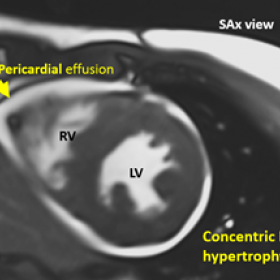 ECG gated white blood short axis view in the mid-ventricular level showing concentric left ventricular hypertrophy and mild p