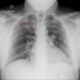 Chest X-ray shows a small opacity in the right upper perihilar region