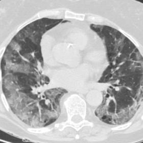 Non-contrast chest CT obtained in the emergency department showed bilateral subpleural ground-glass opaci-ties (GGO) with cra