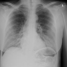 AP bedside chest X-ray. This demonstrated a normal size of the heart without evidence of alveolar consolidation or pleural ef