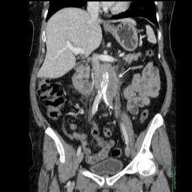 Figure 1a. Coronal (a) and axial (b) contrast-enhanced MDCT images show a hypodense periaortic soft-tissue mass (arrow), with