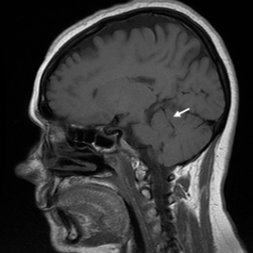 Non-contrast brain MRI showing draining vein (thin white arrows) from small left cerebellar AVM towards the vein of Galen in 