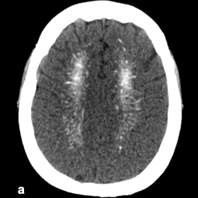 Sequential axial images of a brain CT that illustrate calcifications on the corona radiata (a), subcortical white matter, bas