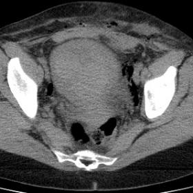 Unenhanced CT scan of the pelvis. Globous uterus with a volumous hematometra is seen.