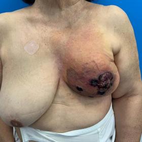 A 76-year-old woman with a previous history of left breast invasive carcinoma treated with radiotherapy eight years ago prese