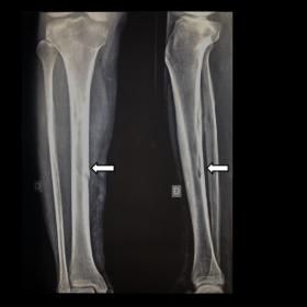 Anteroposterior and lateral radiographs of the right leg showing subcortical and cortical ill-defined lytic lesion at the med