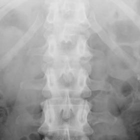 Plain abdominal radiograph. Small clustered calcifications in both kidneys are seen.