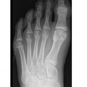 Front radiograph of the left forefoot with subcutaneous amorphous, poorly defined, cloud-like calcifications (green arrow) at