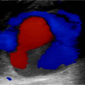 Colour Doppler ultrasound showing the yin yang sign in the humeral pseudoaneurysmal sac.  The “to” component depicts bloo