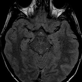 Head MRI: Axial Flair image showing mild non-specific swelling in the right temporal lobe and hippocampus.