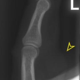A lateral radiograph demonstrates a nonspecific soft tissue swelling on the volar side of the proximal phalanx of the left fi
