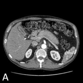 Abdominal CT, performed few days after admission: arterial (B) and delayed venous phase (B). The pancreas is enlarged, with l