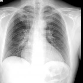 Chest X-ray: the only antero-posterior view performed at bedside did not show obvious parenchymal consolidation or pleural ef