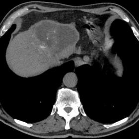 Native axial abdomen CT demonstrates amorphous calcifications in the solid component of the lesion.