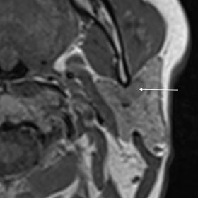 MRI shows ovoid, well-marginated lesion heterogenous lesion within left parotid gland (arrow) predominantly hipointense on T1