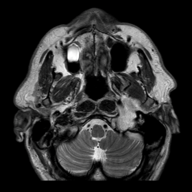 Axial T2-weighted MR image shows a well-defined T2-hyperintense mass centered at—and expanding—the left jugular foramen (