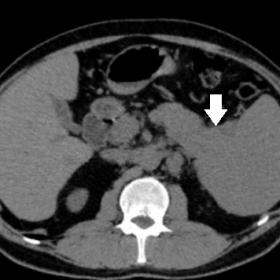Axial CT:  hypovascular heterogeneous tumor: a – unenhanced phase, b – arterial phase, c – portal phase, d – delayed 