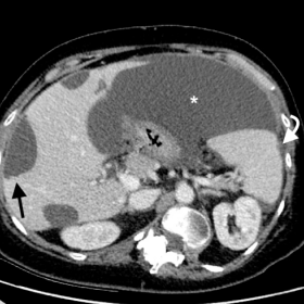 : Enhanced CT in portal phase, axial plane. Note the low-attenuation ascites (asterisk) with mass effect and the typical scal