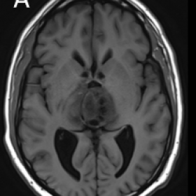 Initial brain MRI obtained 3 days after admission. Axial T1-weighted (A), T2* GE (B), DWI (C) and apparent diffusion coeffici