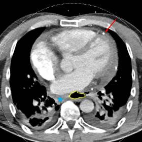Contrast-enhanced thoracic CT, axial images (a, b, c). Pericardial drain (red arrow) with a moderate amount of residual peric
