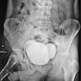 VCUG shows bilateral contrast filled outpouchings arising from urinary bladder.