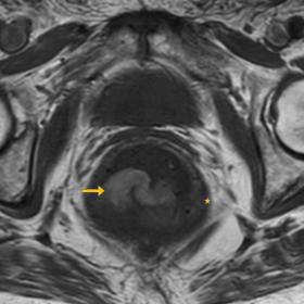 A) MRI axial T1 weighted image - Note the endoluminal tumour (yellow arrow) with spontaneous high intensity due to the presen