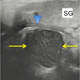 gray-scale transverse ultrasound shows a well-defined hypoechogenic structure (arrows) located deepper to the submandibular g