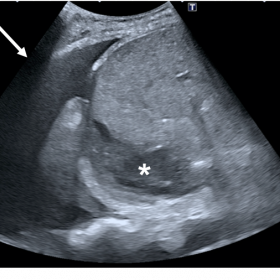 Renal ultrasound. A. Right sided pleural effusion (arrow) and heterogeneous fluid collection in the hepatorenal recess (aster