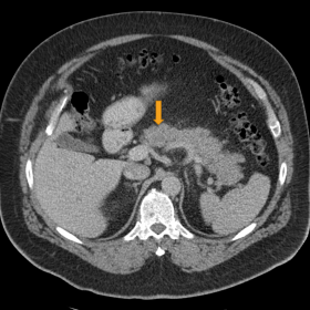 Axial (a) and coronal (b) contrast-enhanced CT images demonstrating hypodensity and edema of the head of the pancreas.