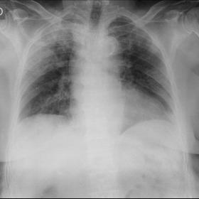 Portable chest X ray performed at the emergency department that shows peripheral infiltrates located in the right superior re