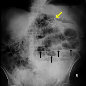 Distended small bowel loops, with multiple air-fluid levels (black arrows), and a radiopaque marker (yellow arrow) compatible
