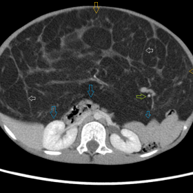 Contrast enhanced CT abdomen soft tissue window axial view showing a large, gross fat containing lesion in the abdomen abutti