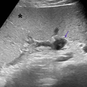 Abdominal ultrasonography depicts a solid, well-circumscribed and homogeneous “comma-shape” mass, with an echogenicity si