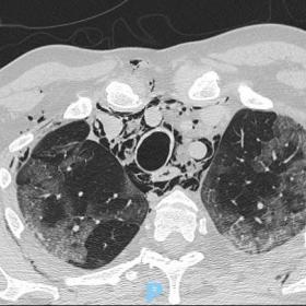 Axial chest CT at day 10 from admission shows evidence of pneumomediastinum with great amount of air decompressing along cerv