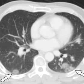 Contrast enhanced CT abdomen and pelvis in lung window demonstrates patchy, peripheral-predominant ground glass opacities at 
