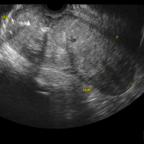 Enlarged and heterogeneous uterus with complete loss of zonal anatomy. Also note the echogenic focus