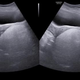 Images of trans abdominal ultrasonography in axial (A)and sagittal (B) views showing a well circumscribed markedly hyperechoi