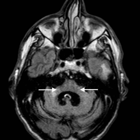 Axial FLAIR image shows severe bilateral volume reduction of the middle cerebellar peduncles (arrows). Hyperintensity in the 