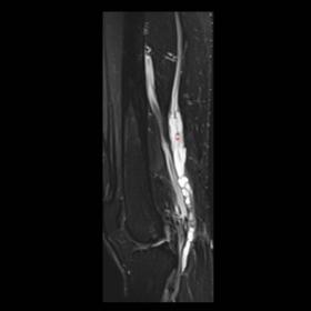Sagittal T2WI MRI sequence with fat saturation shows a voluminous multiloculated tubular lesion along the course of tibial ne