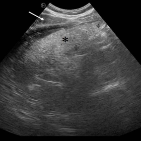US image of a hyperechoic, oval-shaped lesion (*) of the dimensions of 59 x 15mm, with smooth margins under the right epatic 