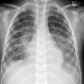 Portable chest radiograph demonstrating moderate pulmonary edema. No evidence of barotrauma, such as pneumothorax or pleural 