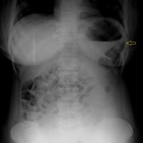 Absence of normal splenic shadow. Few gas-filled bowel loops are seen occupying the splenic fossa in the left upper quadrant