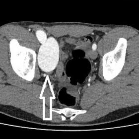 CT with contrast medium- axial view: ectasia of the right external femoral vein