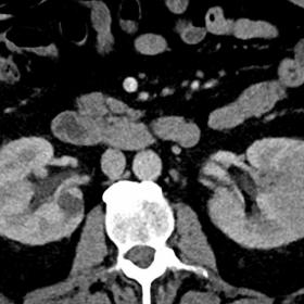 Contrast enhanced axial (a, b) and coronal (c) CT abdomen showing large well demarcated, lobulated, mildly hypodense lesions 