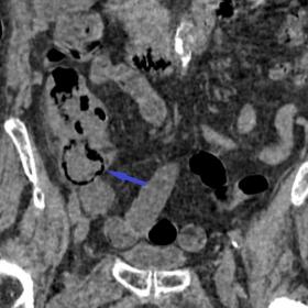 Coronal non-contrast CT scan showing a linear arrangement of gas bubbles along the cecal wall (pneumatosis intestinalis).